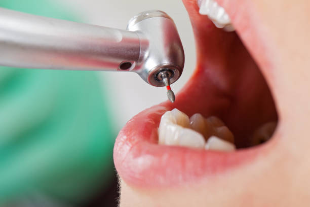 Best Emergency Tooth Extraction in Monsey, NY